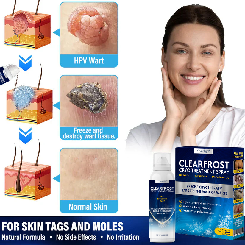 Oveallgo® PRO ClearFrost Cryo Treatment Spray