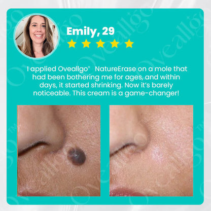 ✅ Official Store: Oveallgo® NatureErase Instant Mole & Spot Cream